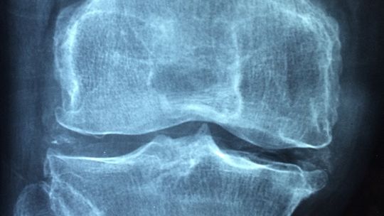 ZDROWIE. Polski wynalazek ma szansę zrewolucjonizować leczenie osteoporozy