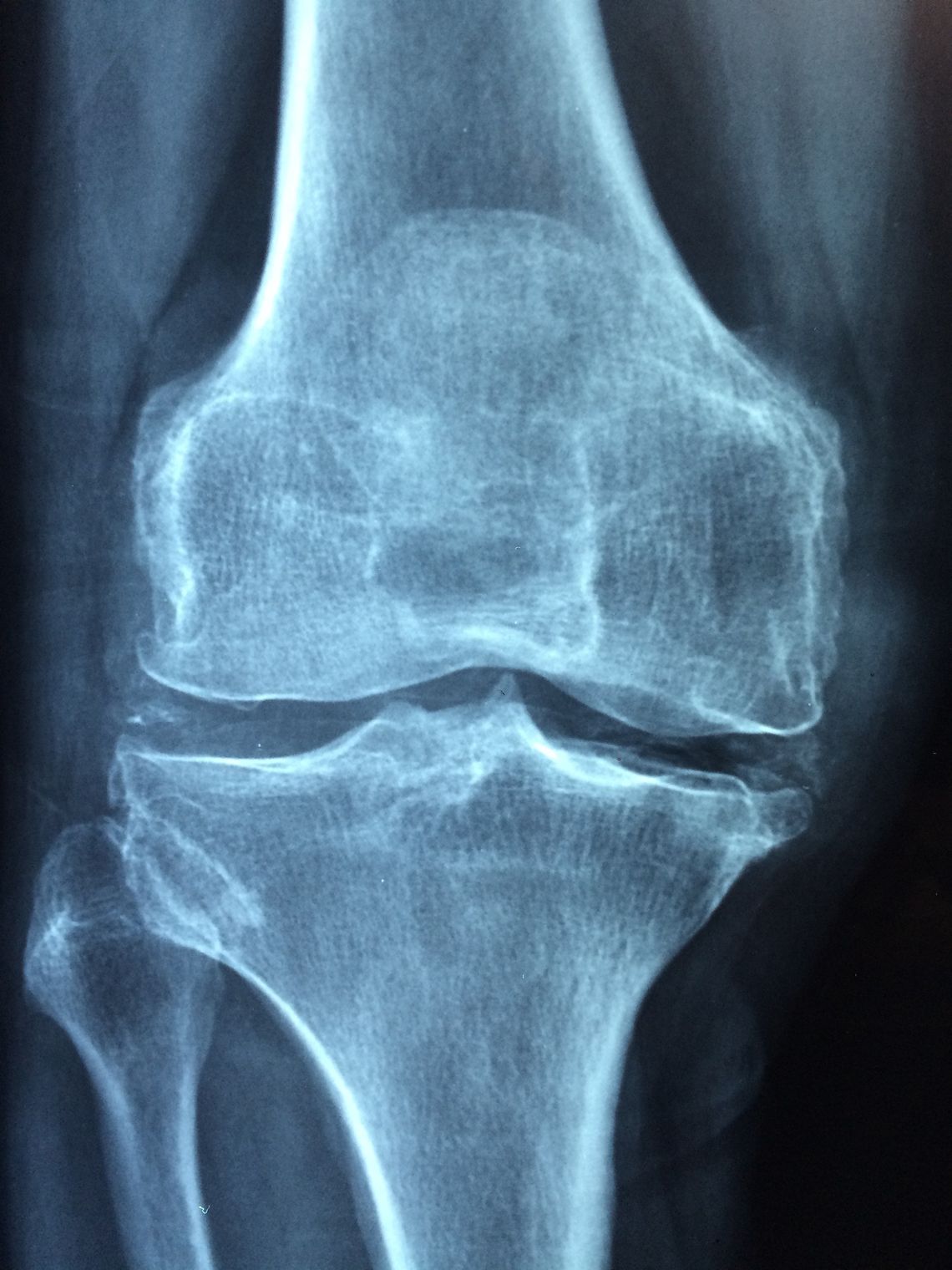 ZDROWIE. Polski wynalazek ma szansę zrewolucjonizować leczenie osteoporozy